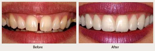 Dental Contouring